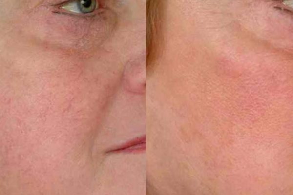 Intense Pulsed Light Before and After