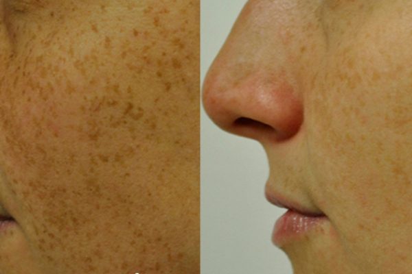 Intense Pulsed Light Before and After 2