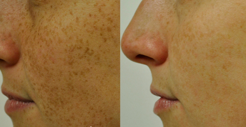 Intense Pulsed Light Before and After 2