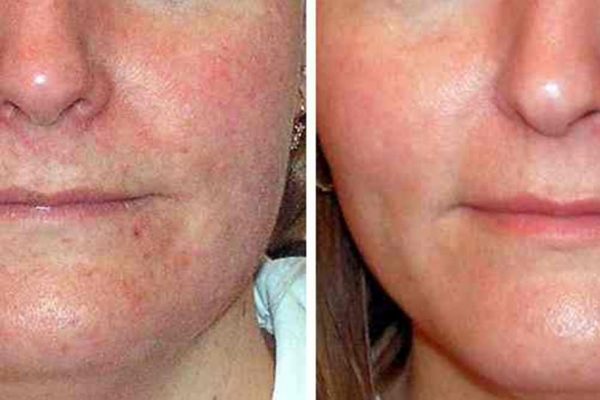 Laser Acne Treatment 2