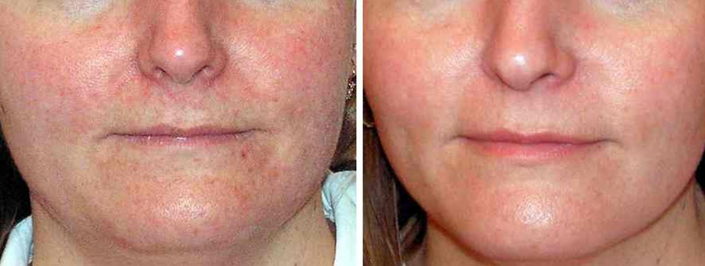 Laser Acne Treatment 2