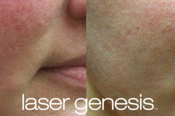 Laser Genesis Before and After 2