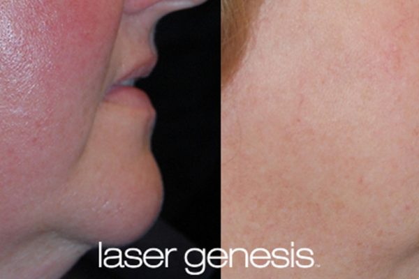 Laser Genesis Before and After 1