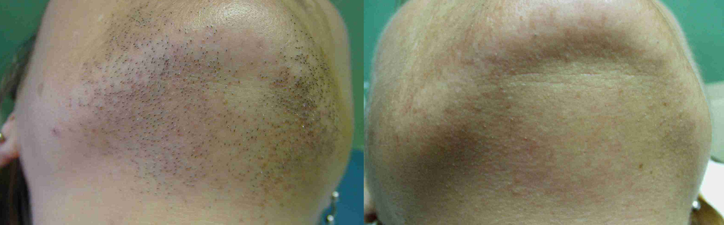 Laser Hair Removal Before and After 1