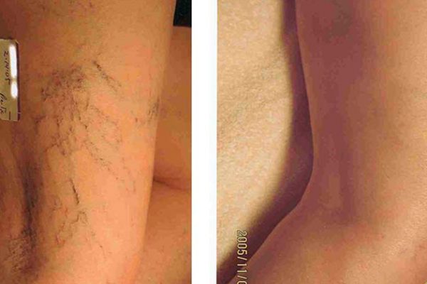 Leg Vein Treatment Before and After 3