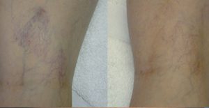 Leg Vein Treatment