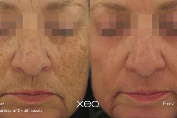 Laser Skin Resurfacing Before and After 1