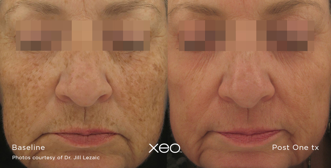 Laser Skin Resurfacing Before and After 1