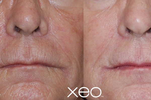 Laser Skin Resurfacing Before and After 2