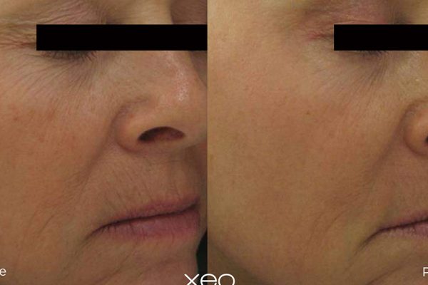 Laser Skin Resurfacing Before and After 3