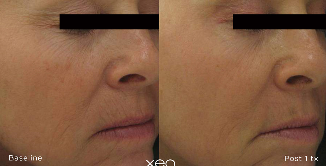 Laser Skin Resurfacing Before and After 3