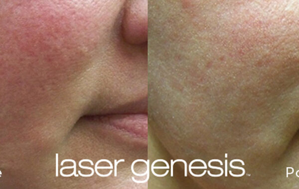 Rosacea Treatment Before and After 1