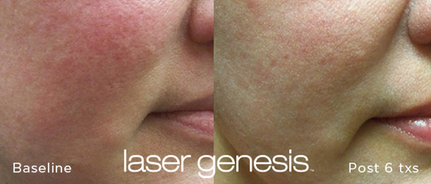 Rosacea Treatment Before and After 1