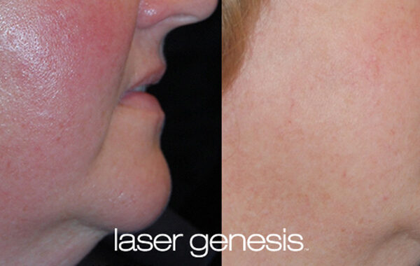 Rosacea Treatment Before and After 3