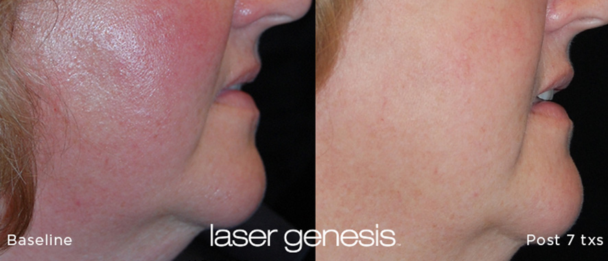 Rosacea Treatment Before and After 3