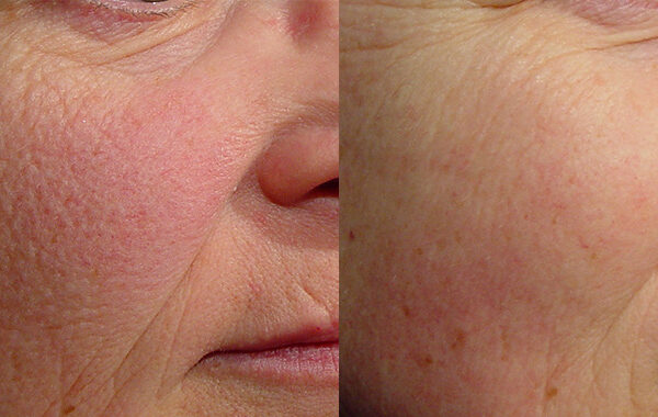 Rosacea Treatment Before and After 2