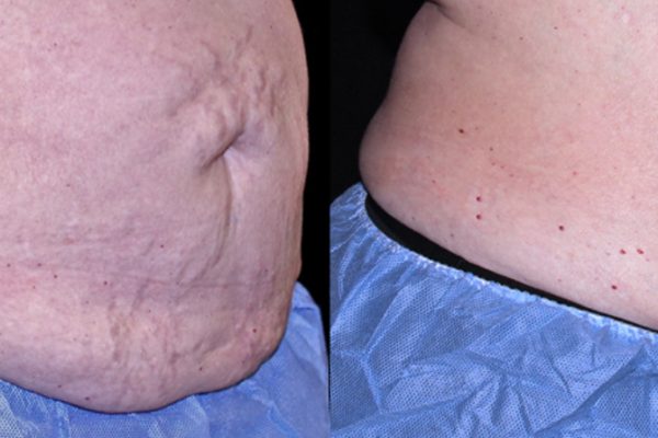 TruSculpt 3D Body Contouring Before and After 3