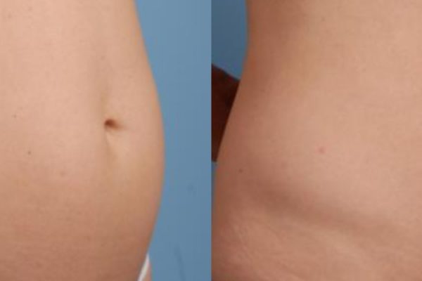 TruSculpt 3D Body Contouring Before and After 1