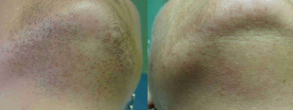 Laser Hair Removal Before and After 1