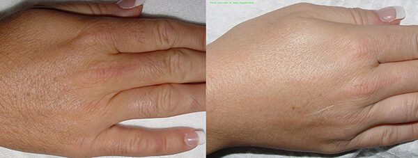Laser Hair Removal Before and After 2