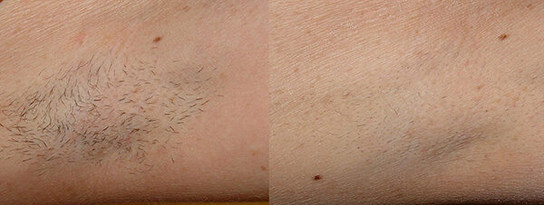 Laser Hair Removal Before and After 3