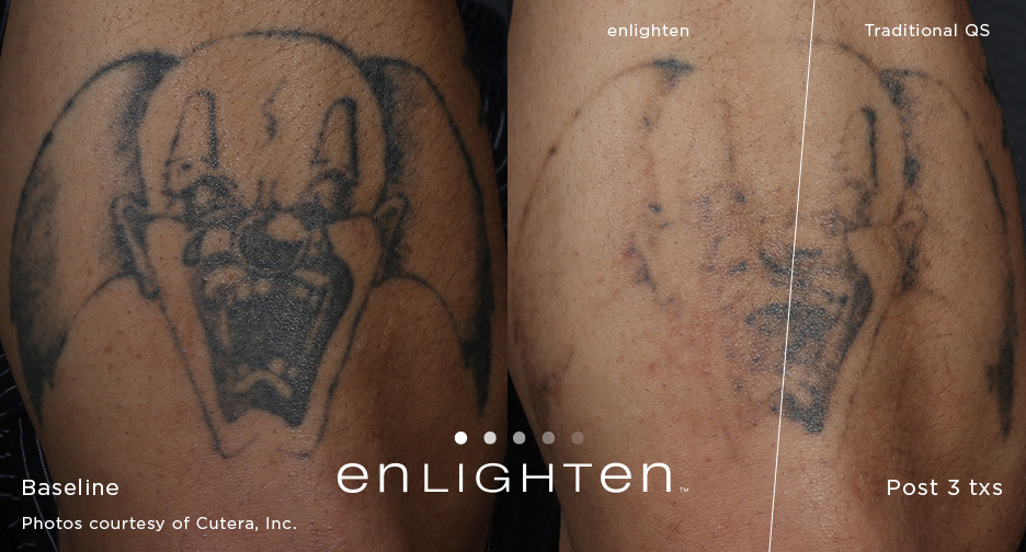 Cutera Enlighten III Pico-Nano Second Tattoo Removal - Best Dental Medical  Shop