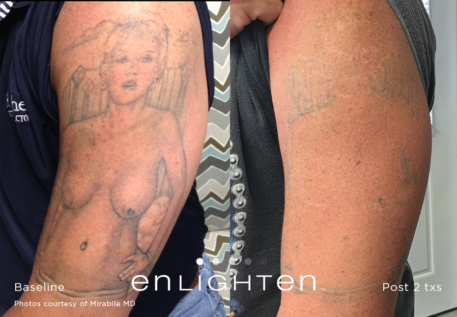 Enlighten Laser Tattoo Removal Boise | Rodgers Center for Plastic Surgery